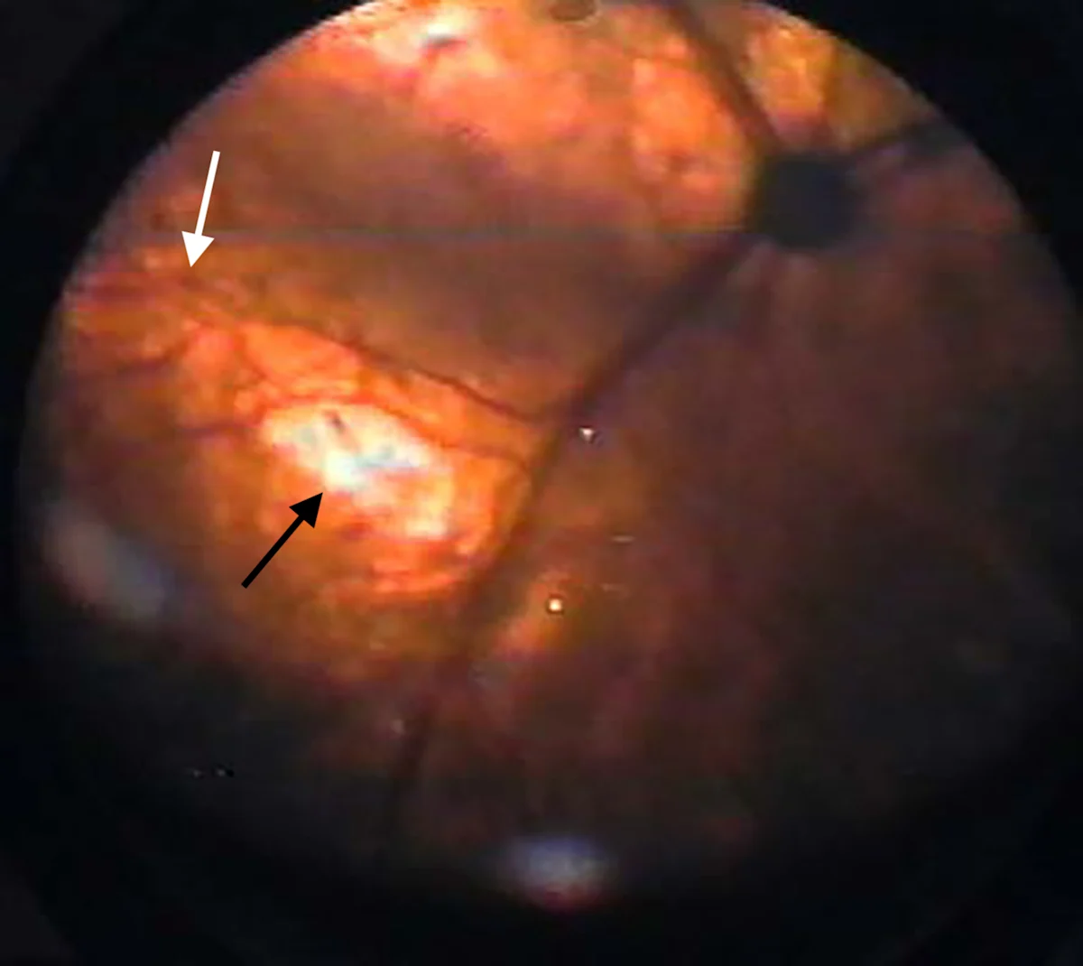 A retinal image of a cat with thin retinal vessels and white focal areas on the fundus.