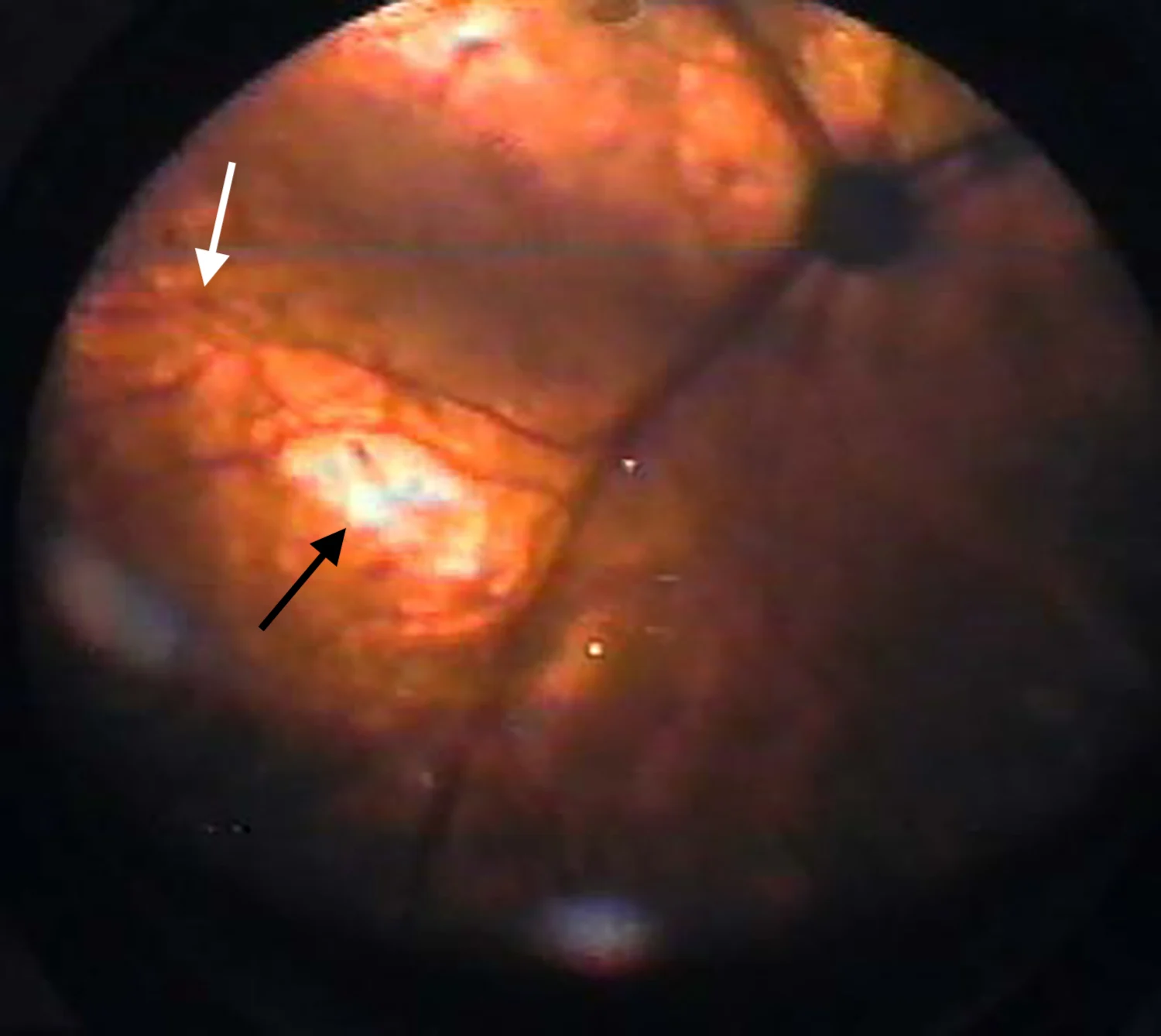 A retinal image of a cat with thin retinal vessels and white focal areas on the fundus.