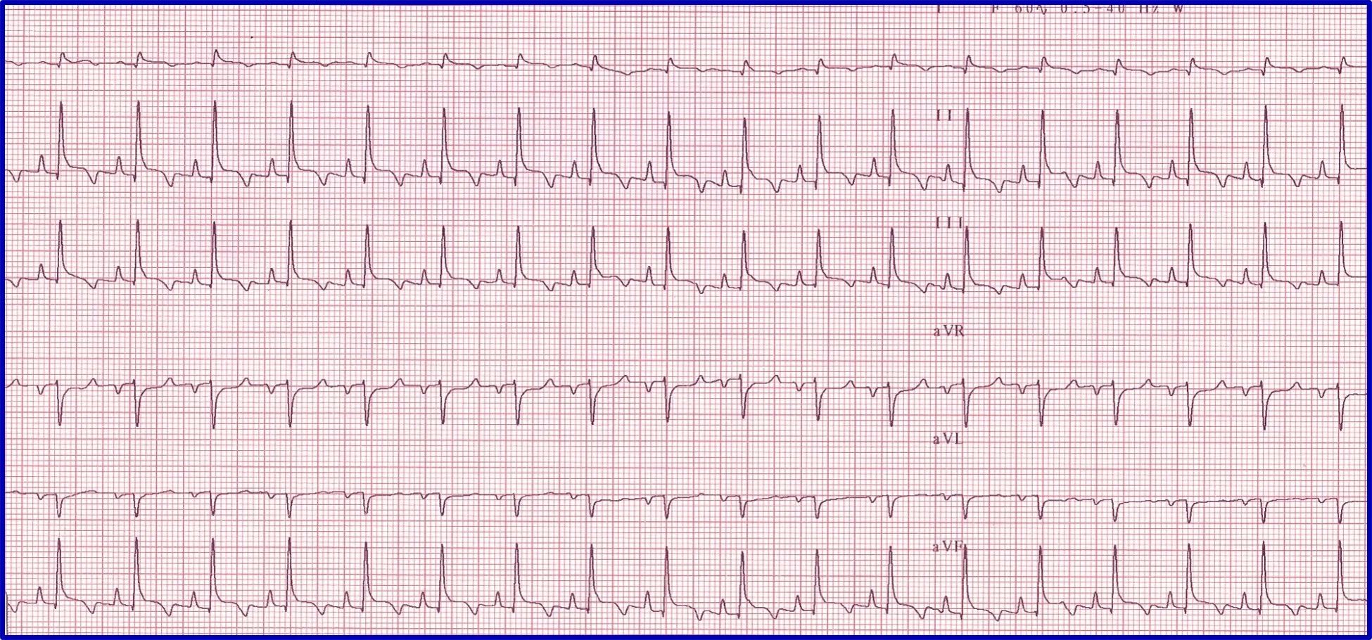 Figure 5A: A 6-lead ECG showing nonconductive P-waves. Figure 5B:  A post-atropine  6-lead ECG showing normal conduction of P-waves.