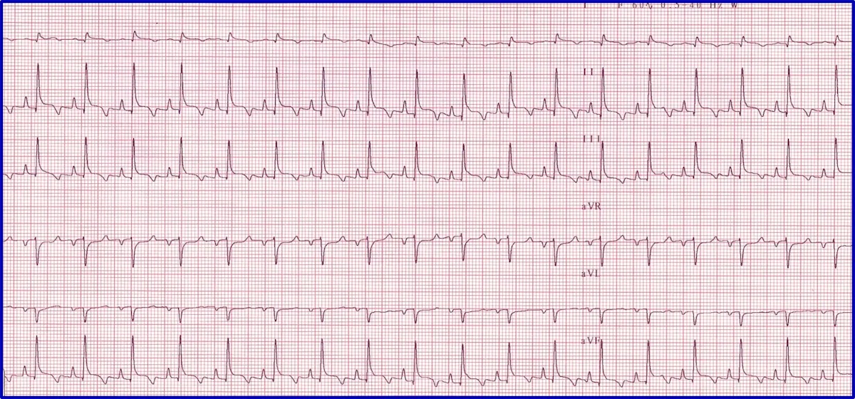 Figure 5A: A 6-lead ECG showing nonconductive P-waves. Figure 5B: A post-atropine 6-lead ECG showing normal conduction of P-waves.