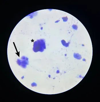 Vaginal cytology slide with arrow pointing to clumped round cells and a star next to clumped mass of cells.
