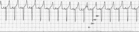 ECG tracing of a sinus rhythm that includes a P wave with a consistent PR interval in front of every wide and negatively deflected QRS complex. 