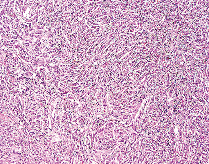 Feline Malignant Nerve Sheath Neoplasm Clinician's Brief