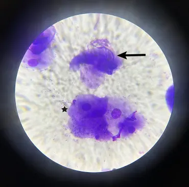 Vaginal cytology slide with arrow pointing to anuclear cell with sharp angles and star near clump of round nucleated cells.
