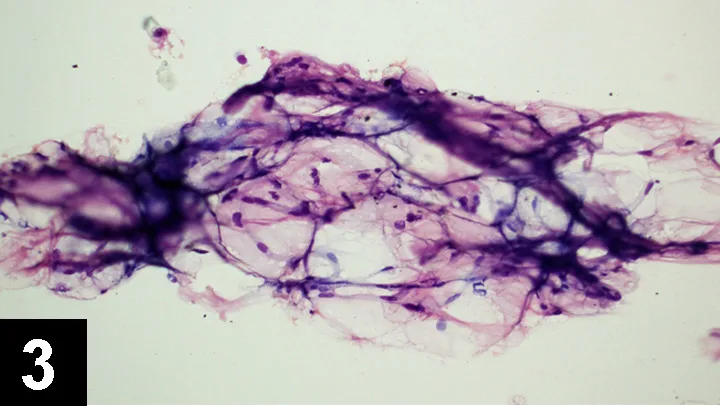 Stained cytology slide showing clear nucleated cells enmeshed in dark purple thready fibers.