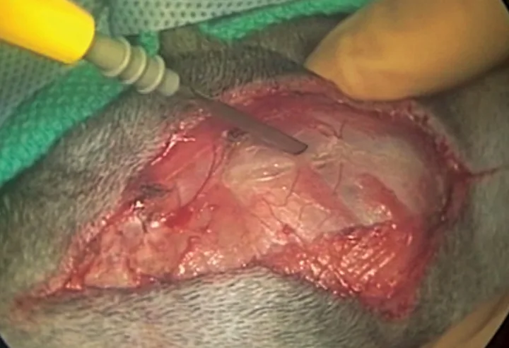 Close-up of incised skin and SC tissue over salivary gland with gloved finger pressing against gland.