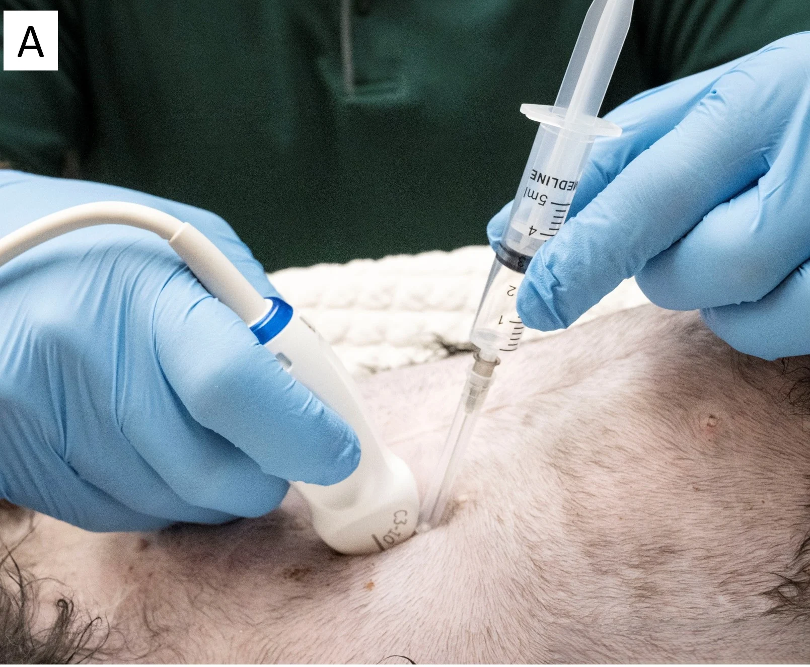 Gloved hands holding ultrasound transducer and syringe showing various angles of the syringe relative to abdomen.