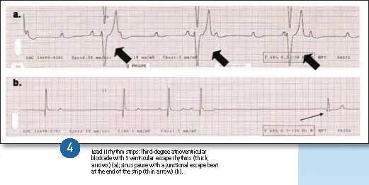 2 lead two rhythm strips with an escape rhythm. The upper strip has a ventricular escape rhythm while the lower shows a junctional escape beat.