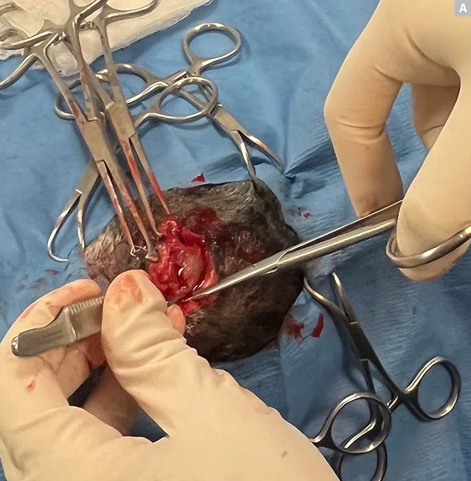 Sequence of images demonstrating deep dissection around globe of eye.