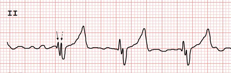 ECG tracing showing R waves composed of 2 distinct peaks with a trough between them.