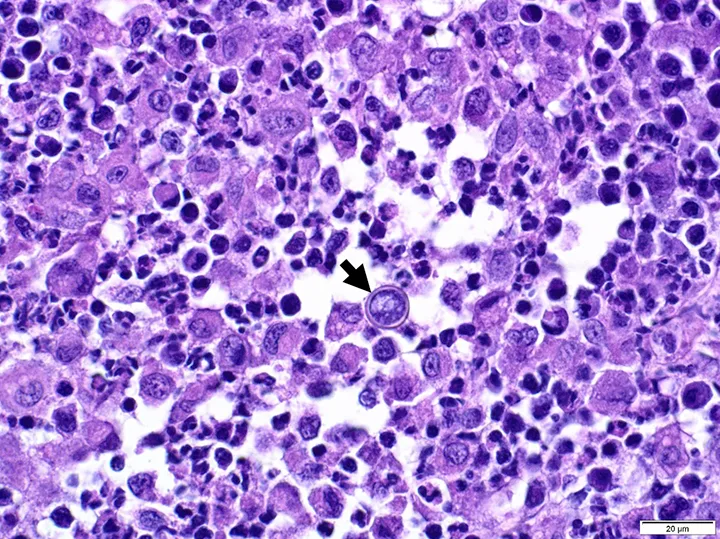 Highly cellular histopathology slide with arrow pointing to a round, thick-walled yeast cell.