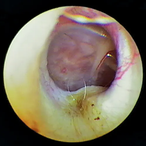 Otoscopic image of pink mass with red striping seen behind ear drum.