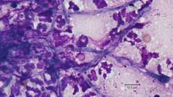 Infectious Diseases of the Nasal Cavity | Clinician's Brief