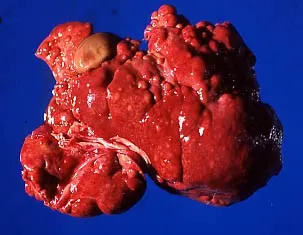 Gross appearance of a liver with small, nodular, irregular lobes.