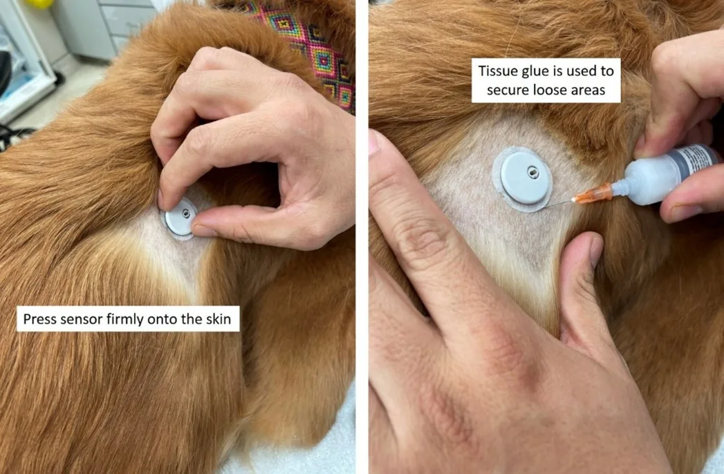 Human hands checking applied continuous blood glucose monitor and applying additional tissue glue.