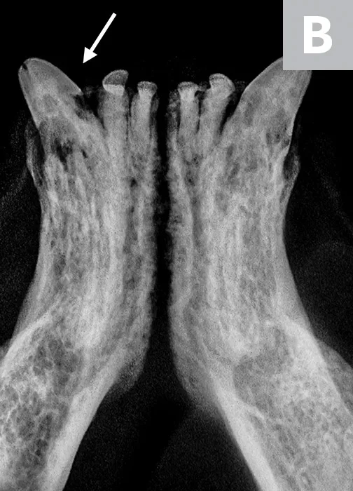Three radiographic images demonstrating the features of Type 1, 2, and 3 tooth resorption.