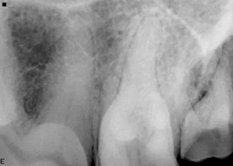 A dental radiograph shows the roots of a canine tooth with visible periodontal disease, including bone loss and changes in the surrounding alveolar bone structure. The image highlights the areas of concern for potential treatment and diagnosis.