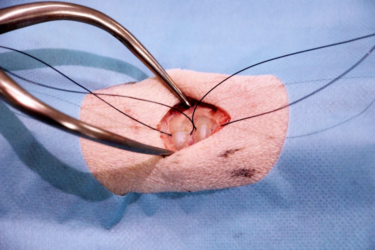Sutures being placed around tracheal rings in preparation for tracheostomy.
