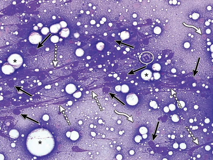 A microscopic image of results from a fine-needle biopsy showing mostly ruptured cells. 