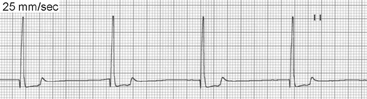 Interpreting ECGs with Confidence: Part 2 | Clinician's Brief