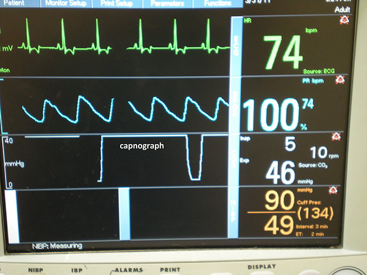 Anesthetic Monitoring Interpreting the Readings Clinician's Brief