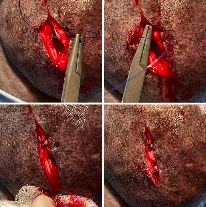 Images showing closure of subcutaneous tissue after incisional biopsy. 