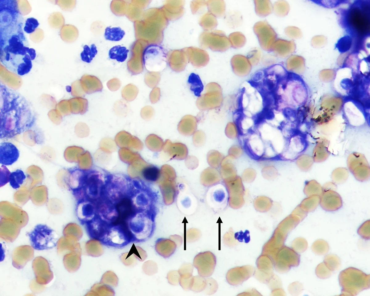 Round organisms with thick, clear walls and central dark staining seen within and outside of macrophages.