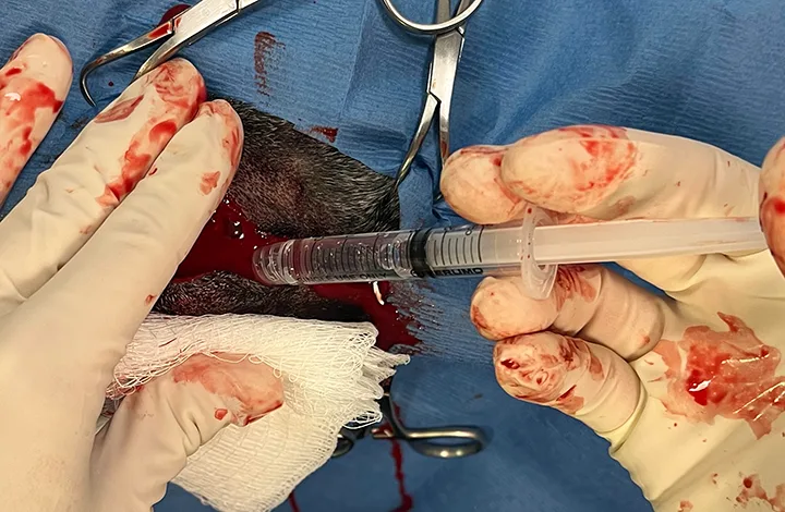 Gloved hands squirting clear liquid from syringe into bloody eye socket.