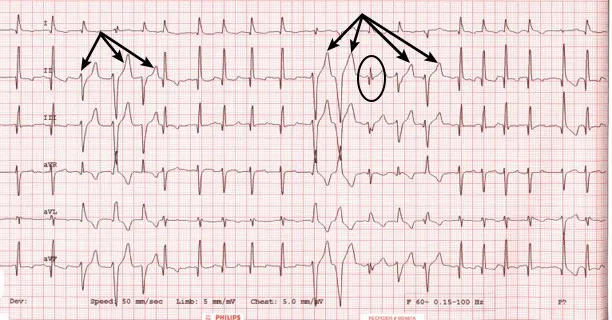 A 6-lead ECG with arrows pointing to wide, bizarre ventricular beats, and a circled fusion beat.