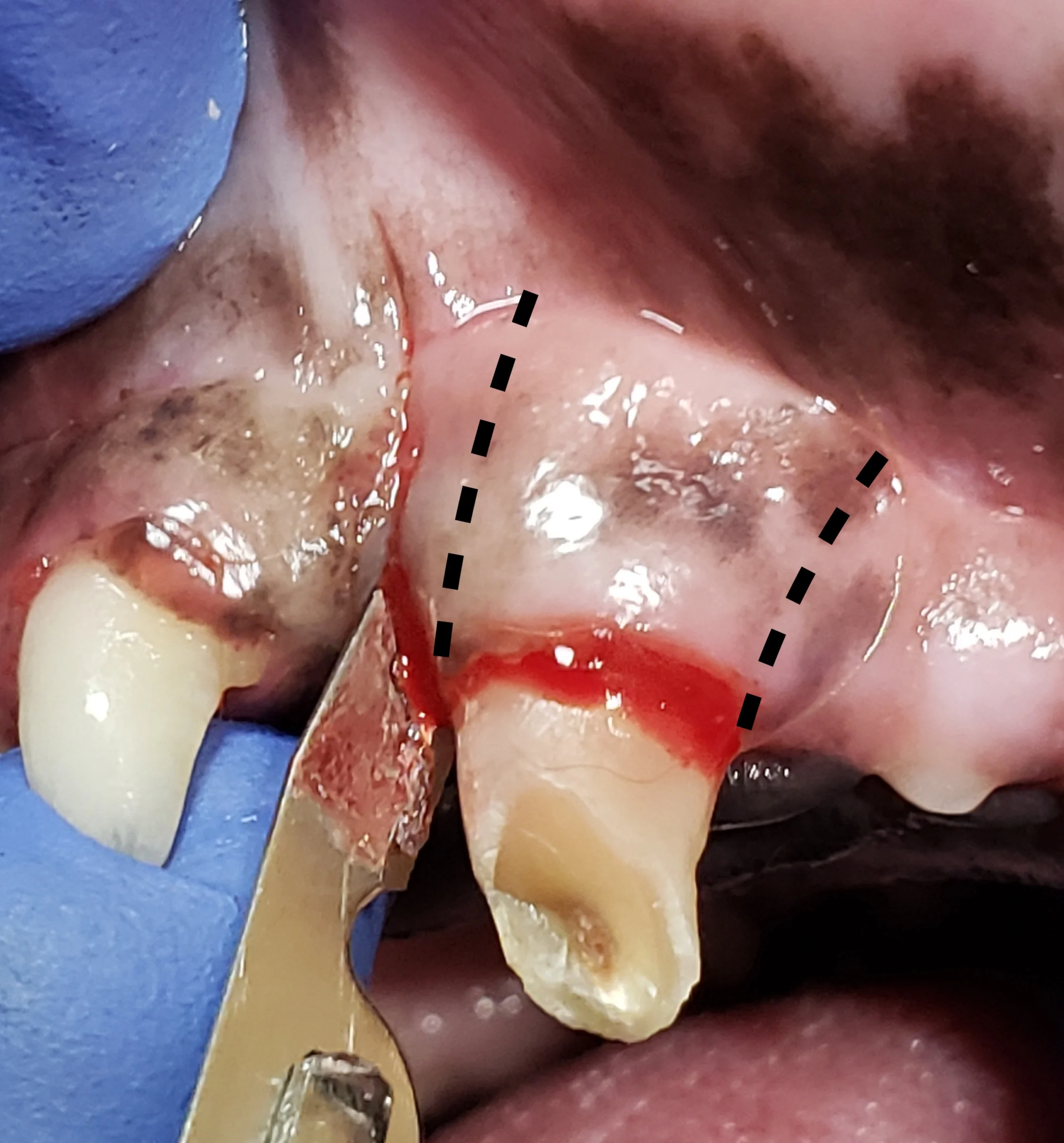 Broken canine tooth in a dog with dotted lines on mucosa illustrating where to incise tissue to create a rectangular flap.