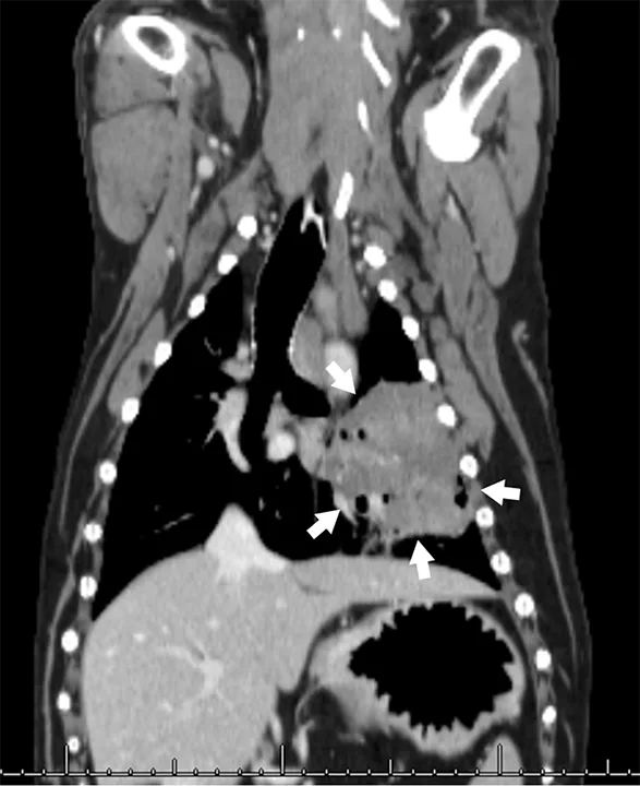 Dorsal CT image of a dog with arrows pointing to a large mass in the lungs.