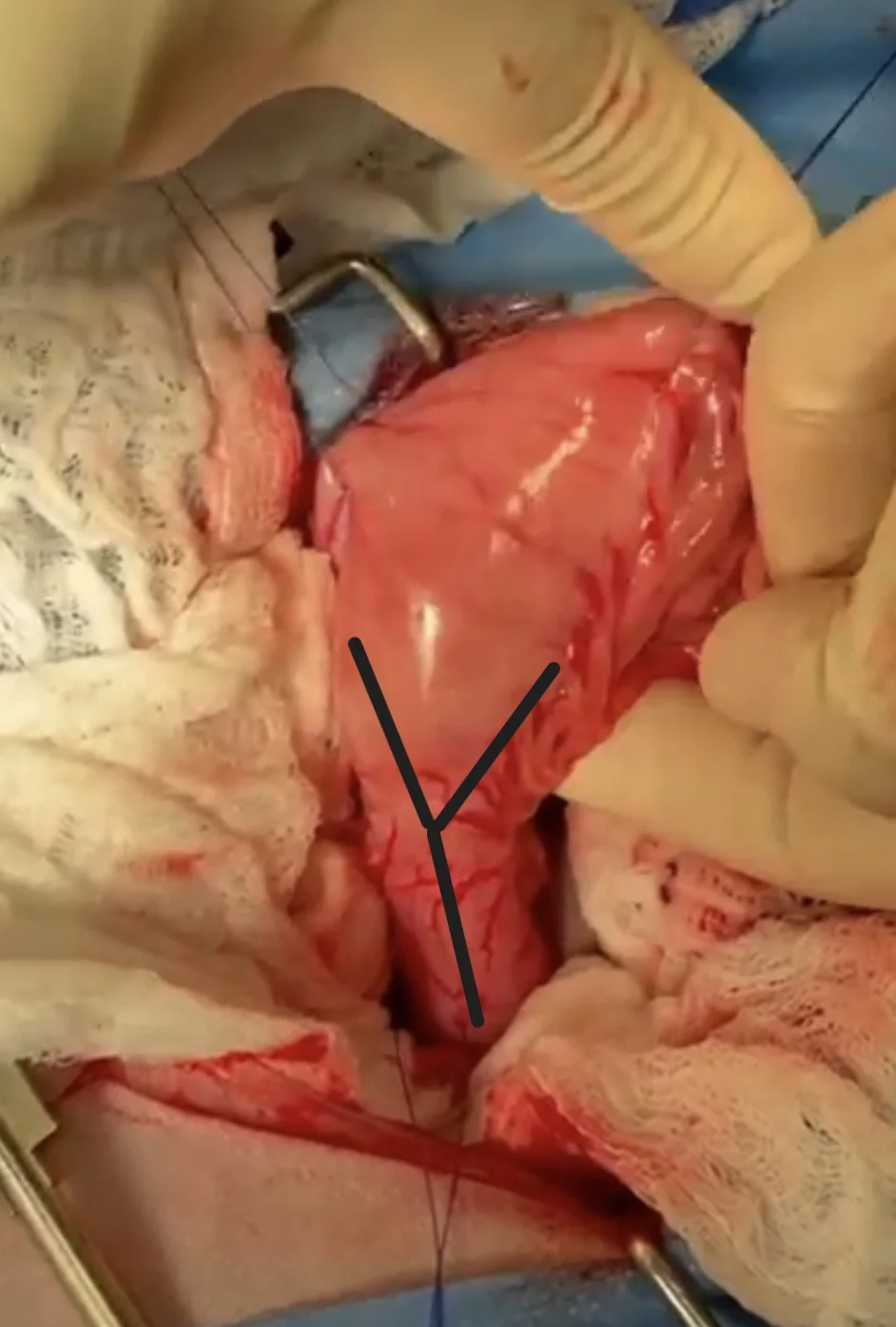 Gloved hand holding an organ with a superimposed Y drawing.