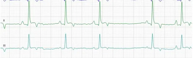 Lead II and III ECG tracings showing irregular R-R intervals and inconsistently shaped P waves.