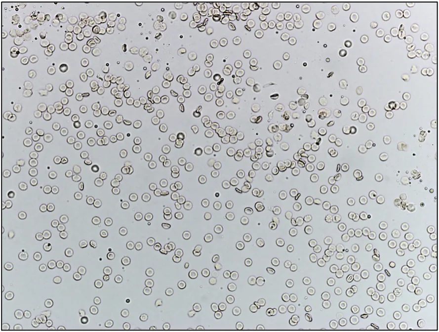 Two unstained urine sediment slides comparing how different urine volumes using the same sample can appear.
