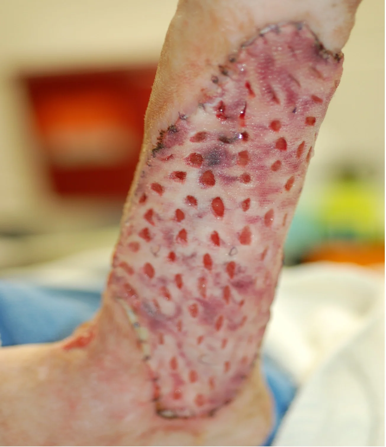 Free skin graft after placement on the limb of a dog.