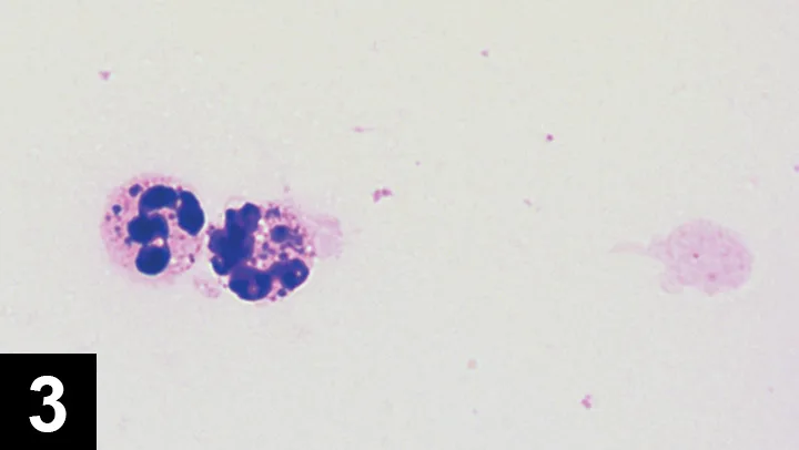 Cytology of joint fluid from a patient with immune-mediated disease.