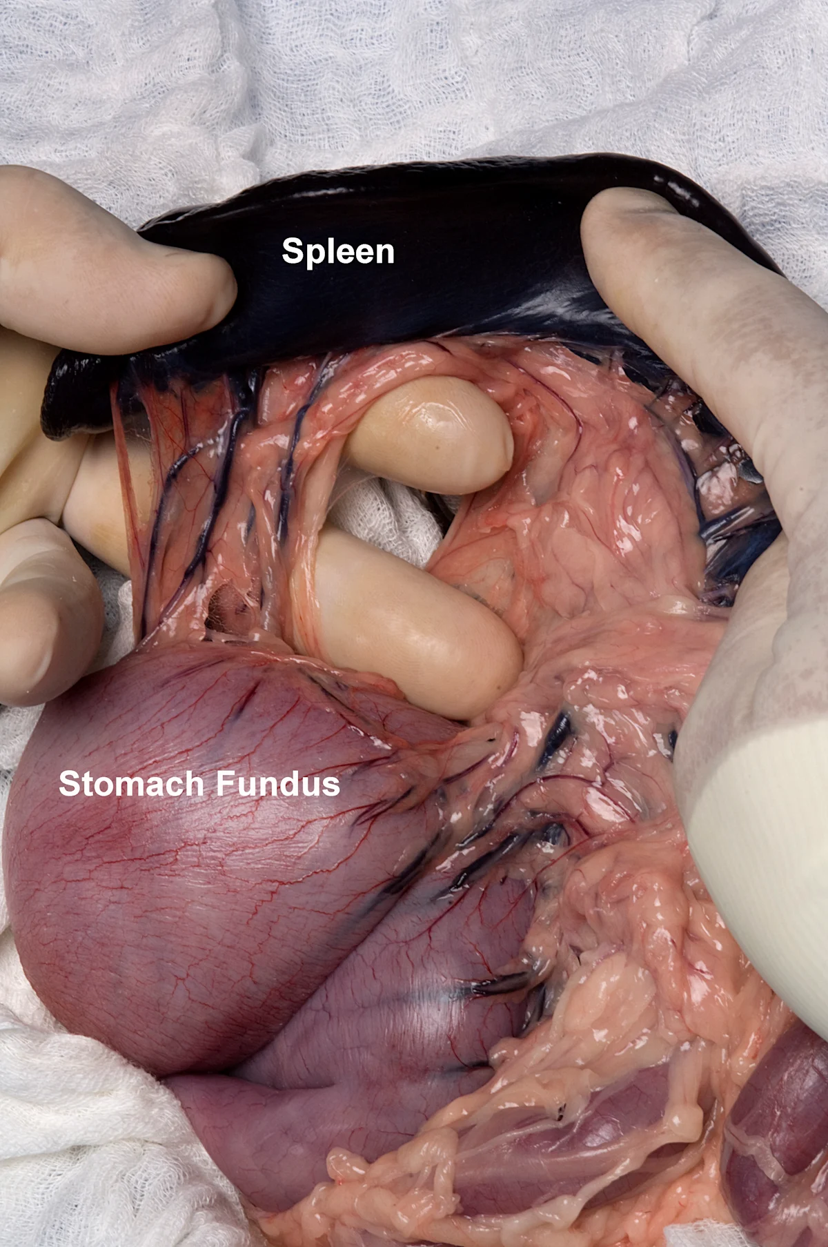 A surgeon is holding the spleen and showing the short gastric vessels.
