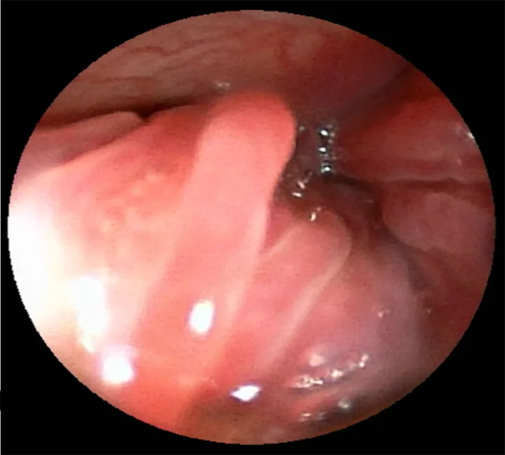 Rhinoscopy image of turbinates in a dog.