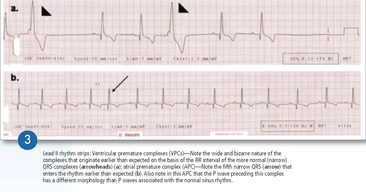 2 lead two rhythm strips with one demonstrating occasional ventricular premature complexes and the other demonstrating an atrial premature complex.