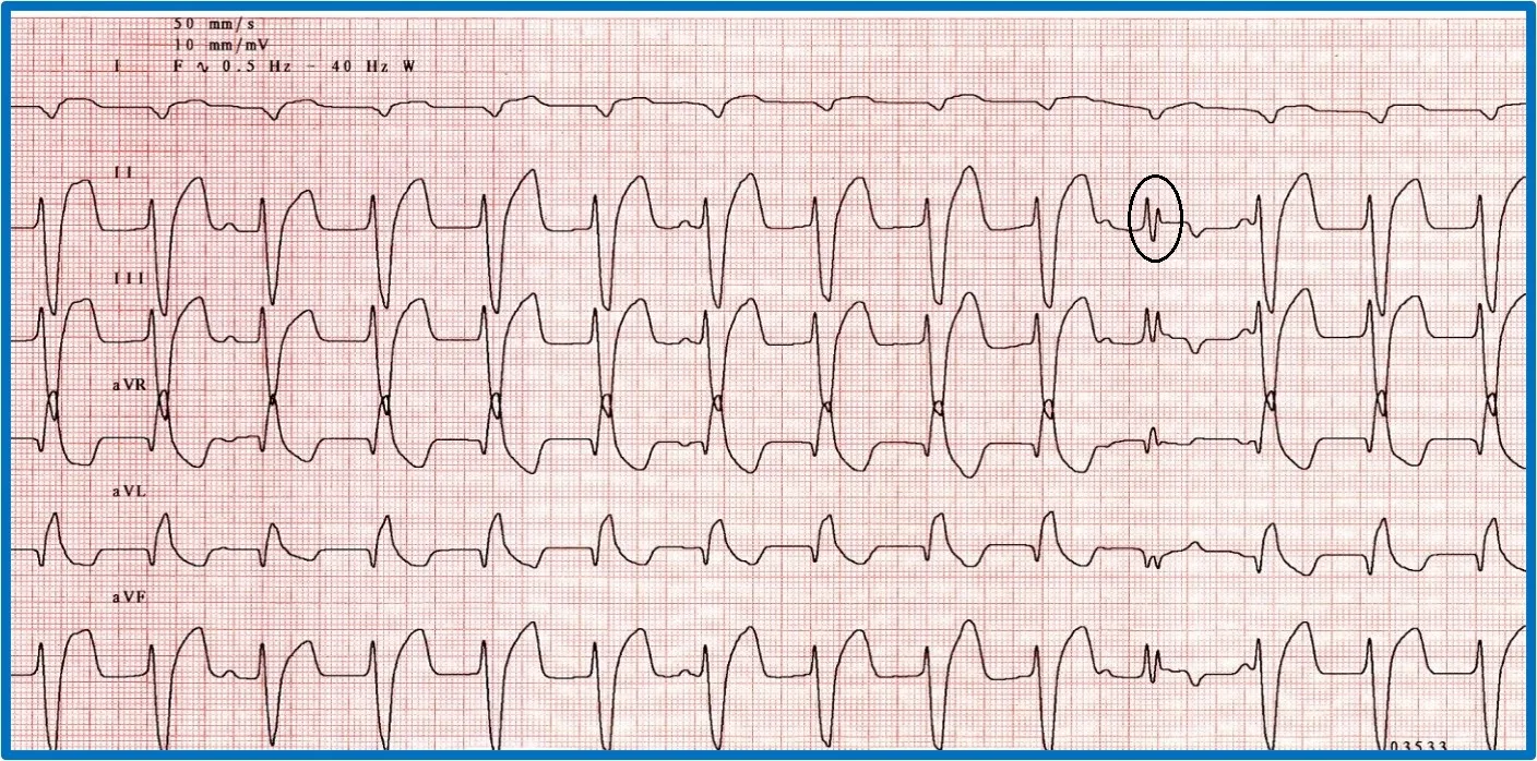 Figure 10A: A 6-lead ECG showing sustained tachycardia. Figure 10B: A 6-lead ECG showing an accelerated idioventricular rhythm and a circled fusion beat. 