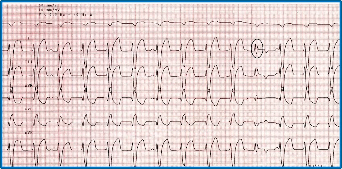 Figure 10A: A 6-lead ECG showing sustained tachycardia. Figure 10B: A 6-lead ECG showing an accelerated idioventricular rhythm and a circled fusion beat.