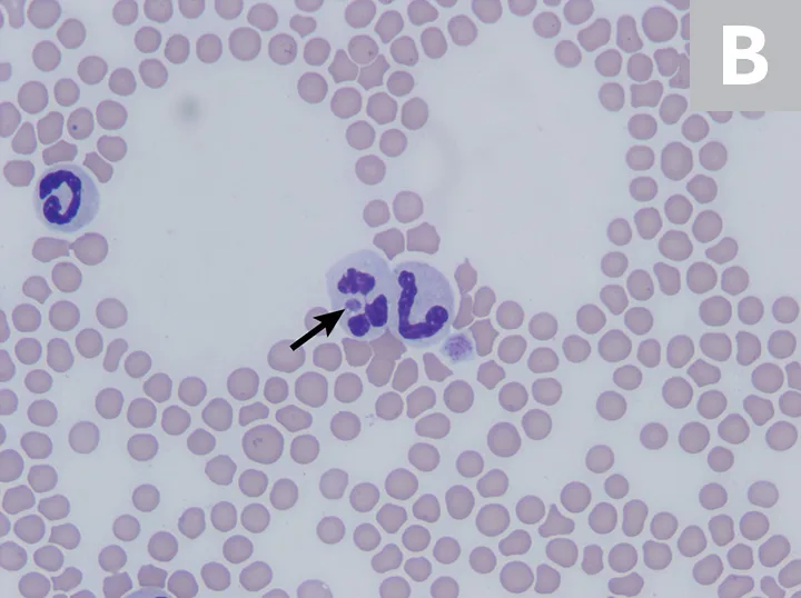 1A: Single neutrophil with arrow pointing to a small round purple-staining object within the cytoplasm. 1B: Three neutrophils, one with arrow pointing to a small round purple-staining object within the cytoplasm.