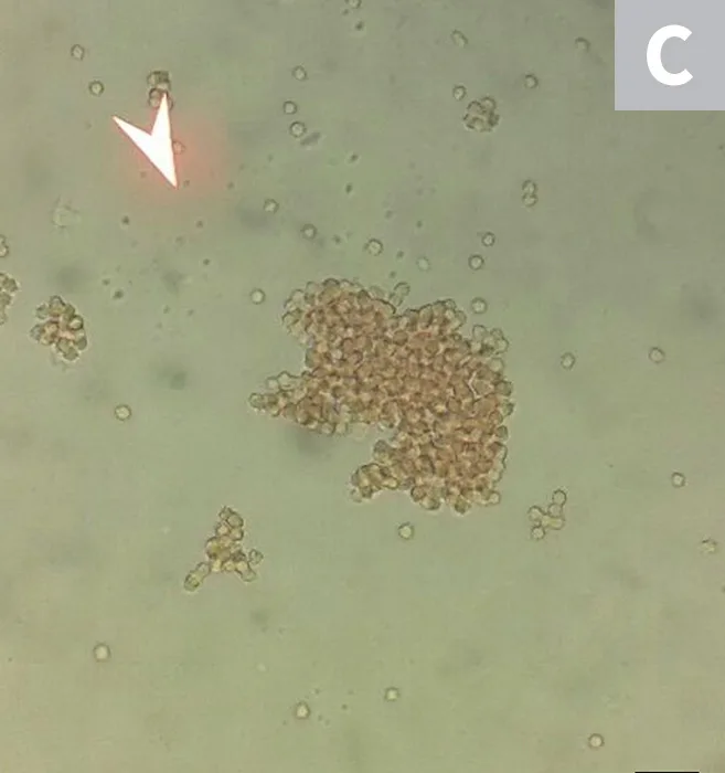 Microscope images of RBCs showing agglutination (A) and rouleaux (B).