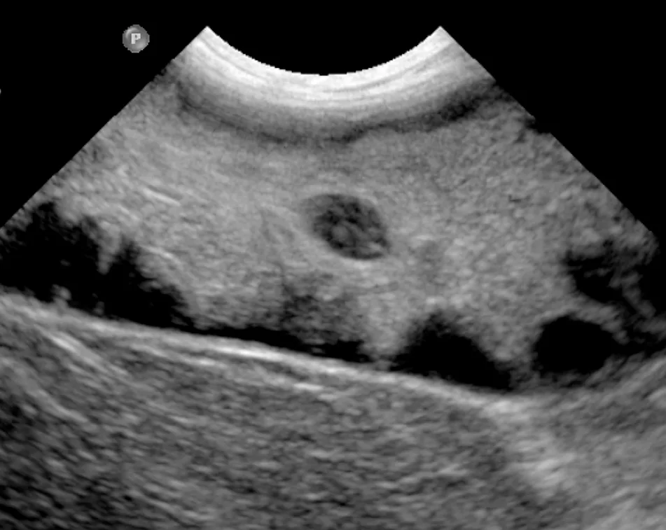 Gallbladder mucoceles showing a stellate pattern on ultrasound.