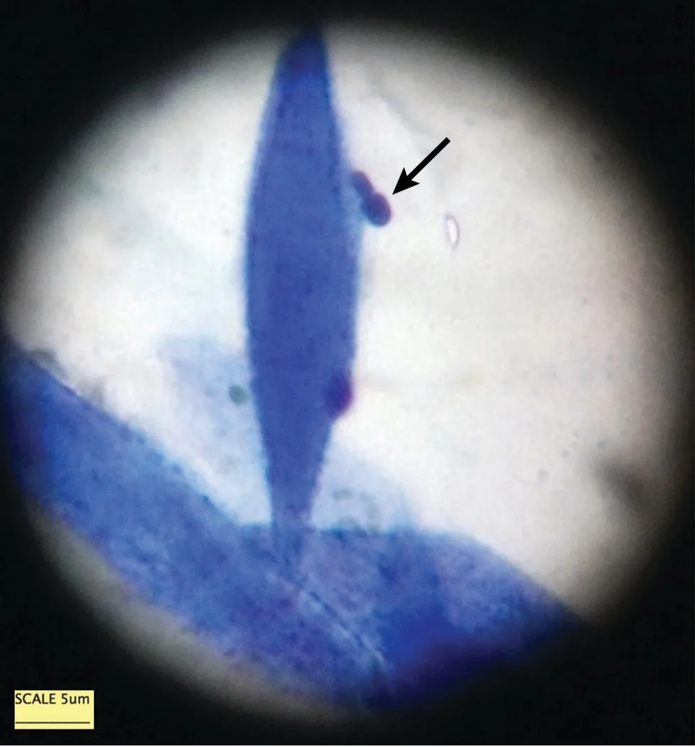 Two microscopic images of cytology obtained by sampling the eyelid margins.