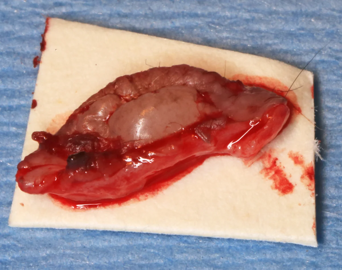 Removed section of an ear pinna, with multiple coalescing vesicles, lying on a surgical drape.