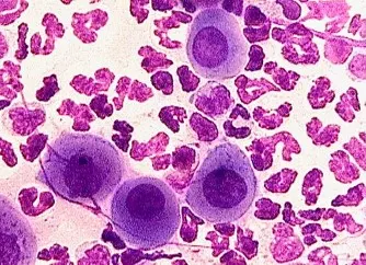 Four round, nucleated cells with purple-staining cytoplasm seen among multiple cells with multilobed nuclei. 