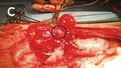 A surgical site shows a mass of red, inflamed tissue surrounding the intestines, with blood evident in the area. Surgical instruments are positioned nearby, indicating an ongoing procedure.