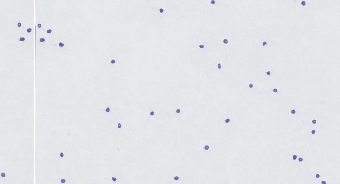 Cytology of pleural fluid showing scant number of dark-staining cells.