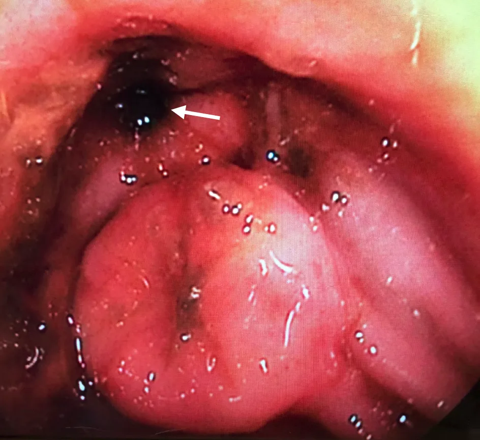 The ileocolic junction of a cat shown during colonoscopy.